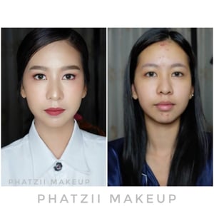 Before // After เอามาให้ดูกันชัดๆ น้องผิวหน้ามีปัญหาสิว น้อง…